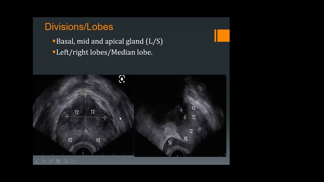 Key aspects of Prostate Ultrasound