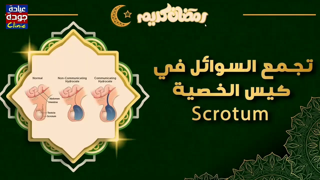 تجمع السوائل فى الخصية | دكتور جودة محمد عواد | دكتور جودة محمد عواد