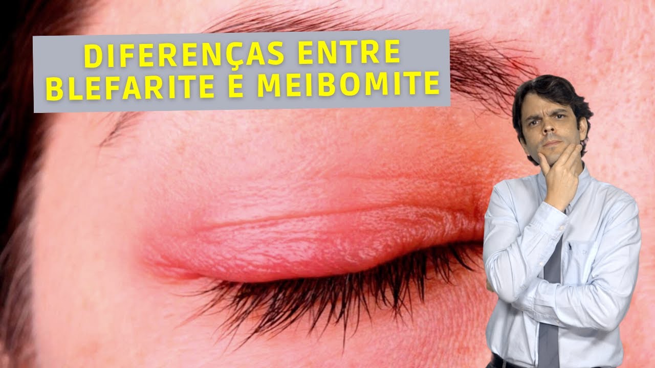 Diferenças entre Blefarite e Meibomite | Dr. João Paulo Lomelino
