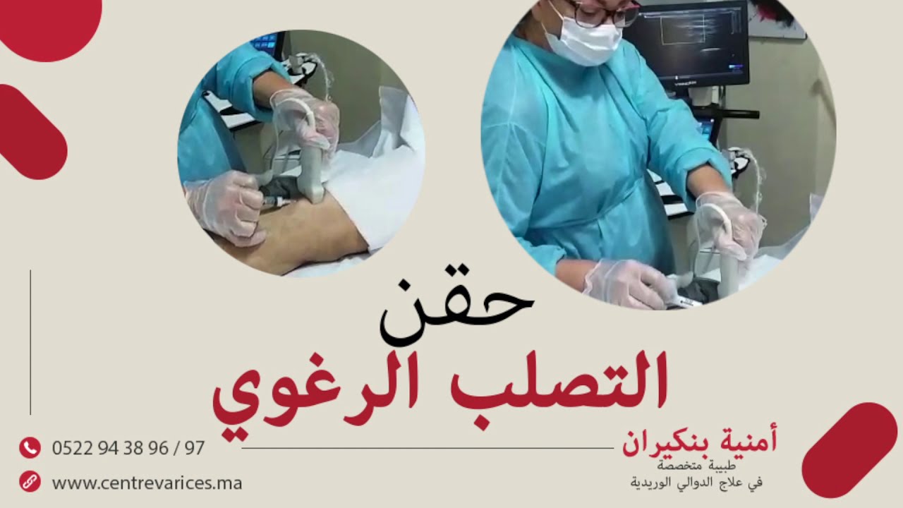 الدكتورة أمنية بنكيران : علاج دوالي الساقين بالحقن.. كل ما يهم عن حقن التصلب الرغوي