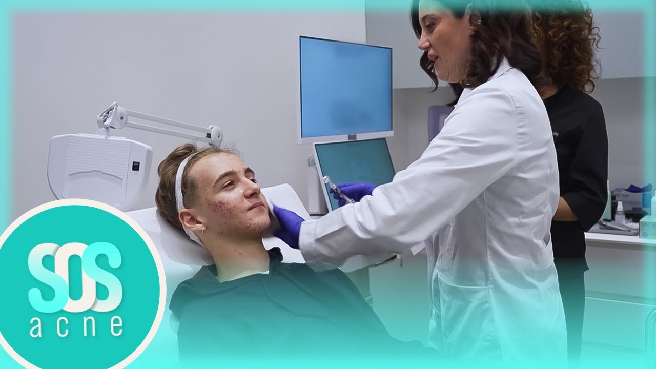 Un ragazzo di 16 anni soffre di acne sul viso | Sos Acne