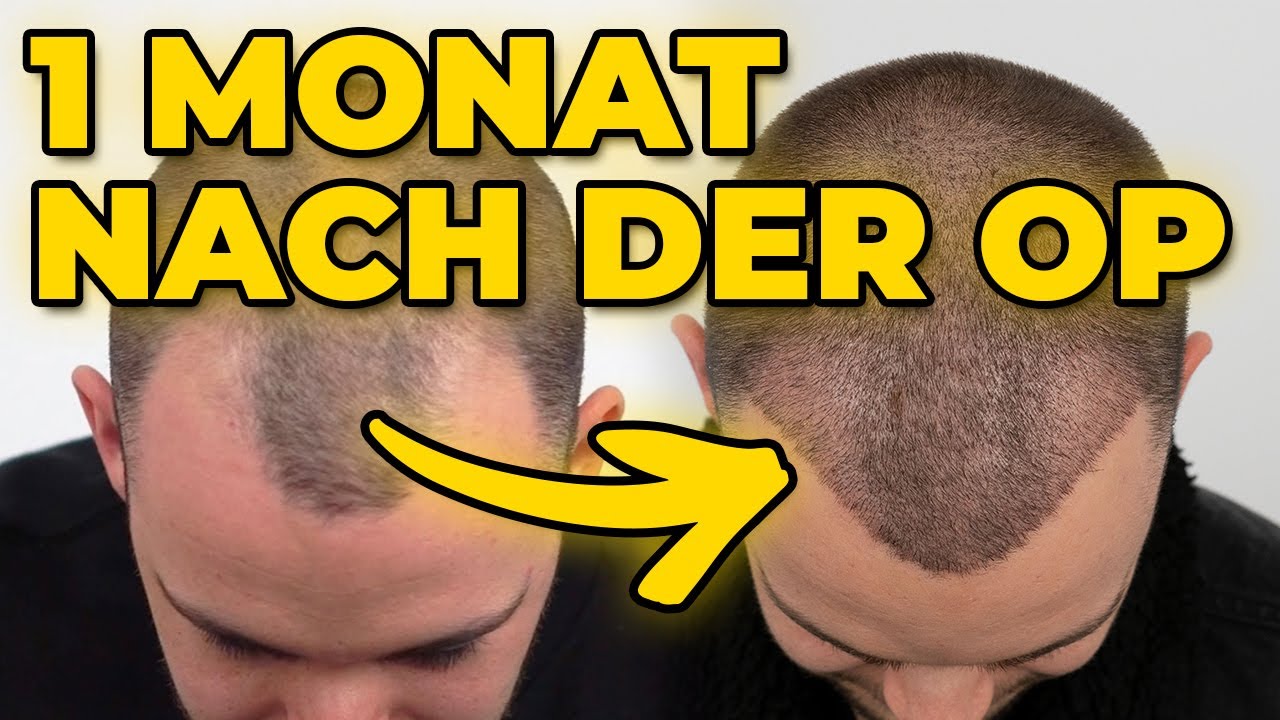 Die kritische Phase ist überstanden | Ergebnis Haartransplantation Elithair