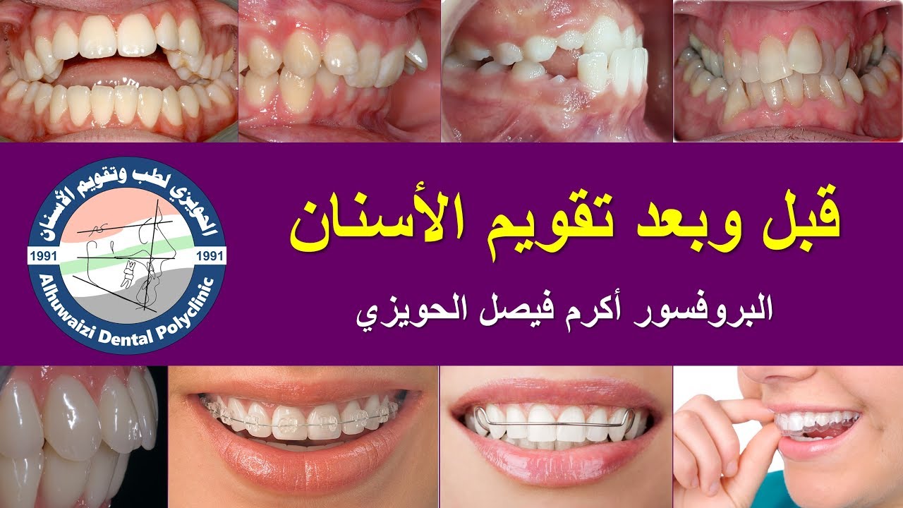قبل وبعد تقويم الأسنان