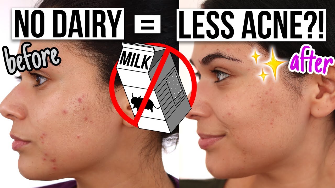 I Went Dairy Free for 30 Days to Help My Acne Heal