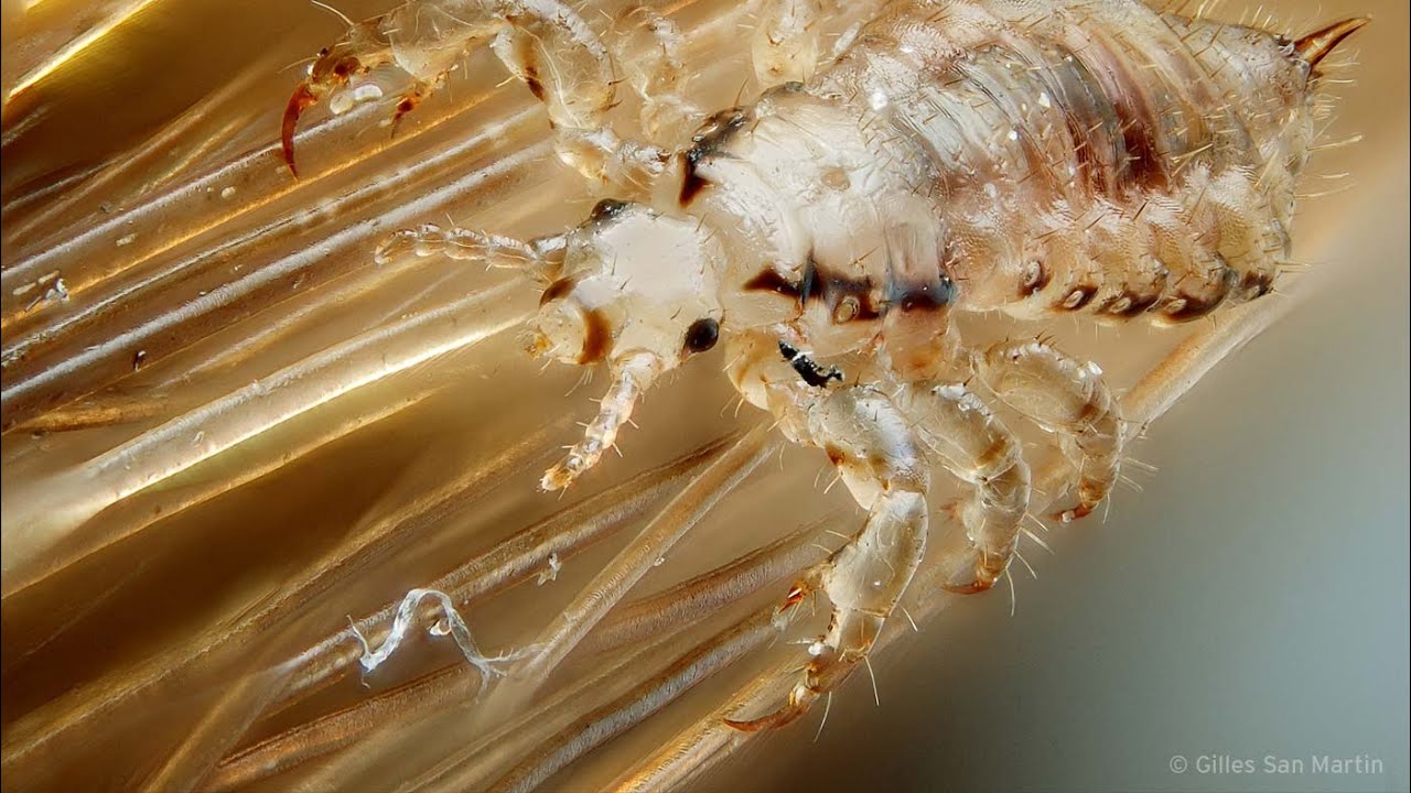 Super Head Lice Spreading Around the World - Behind the News