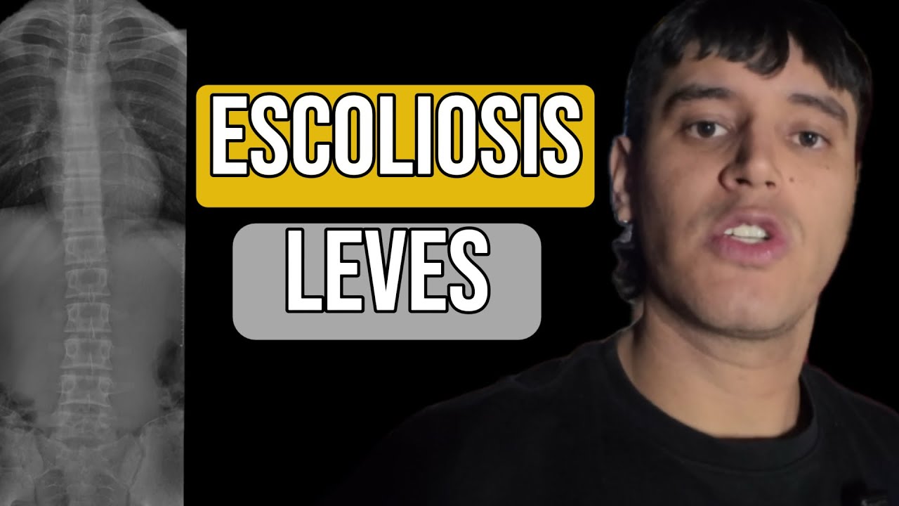 ESCOLIOSIS LEVE 🩻 CONSEJOS Y TRATAMIENTO 