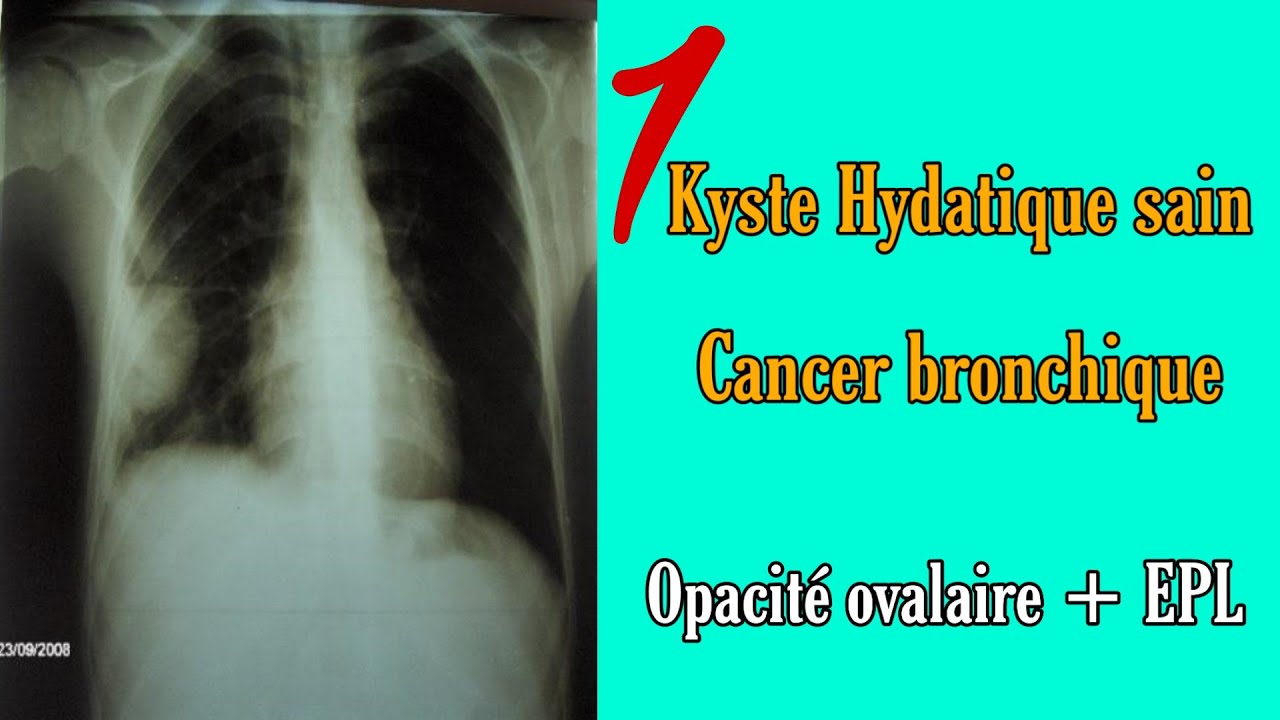 Telethorax 1 : Kyste hydatique sain, cancer bronchique | Opacité ovalaire, EPL