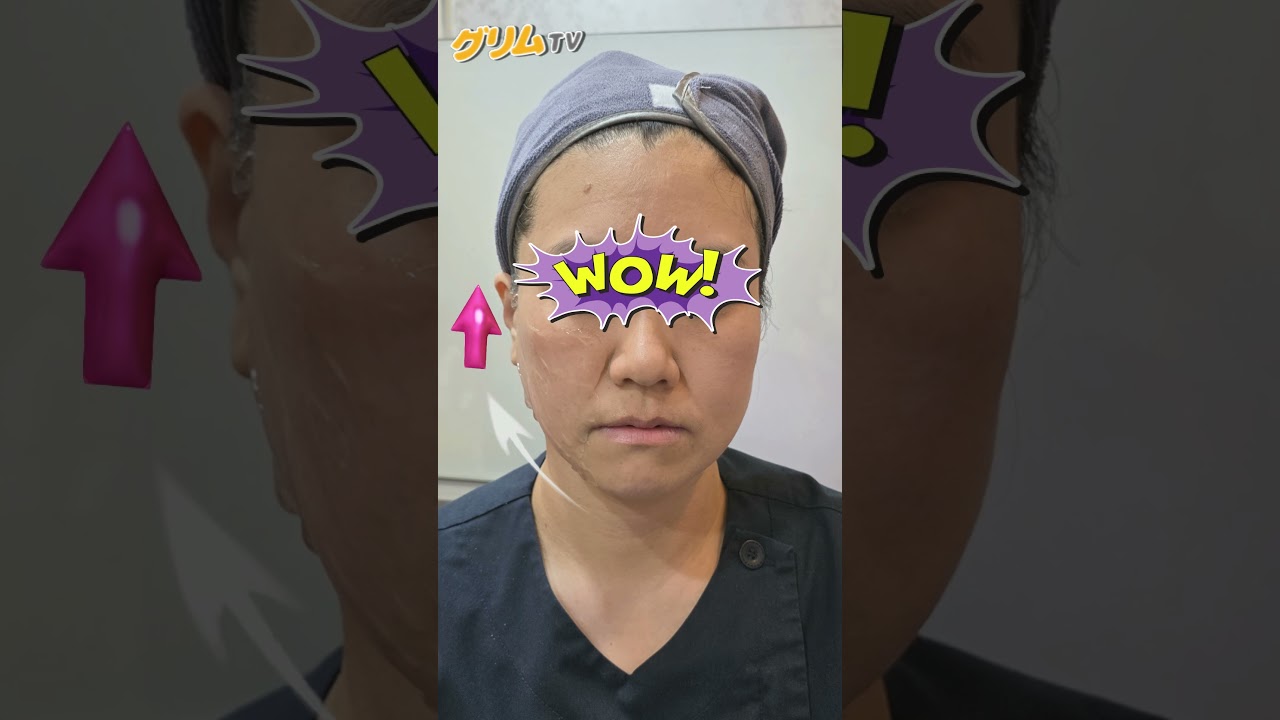 シュリンクユニバース＋スキンボトックス　#韓国皮膚科　#韓国美容 #渡韓　#韓国肌　#スキンケア　#アンチエイジング　#シワ　#毛穴 #コラーゲン　#弛み　#リフトアップ　#Ｖライン　#二重顎　#美白