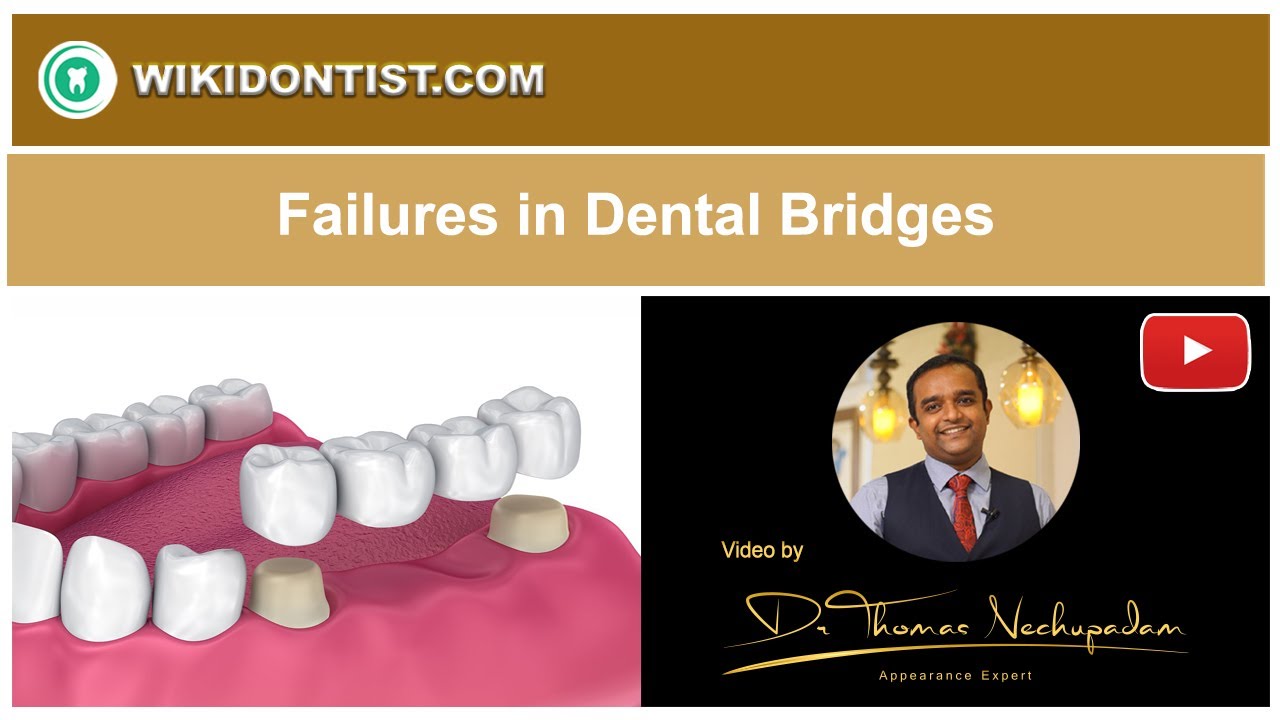 Failures in Dental Bridges/#shorts