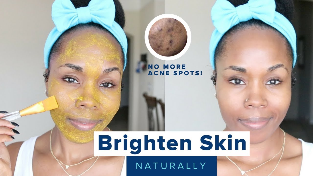 How to Brighten Skin, Reduce Acne Scars, Hyperpigmentation & Discoloration | Home Remedies