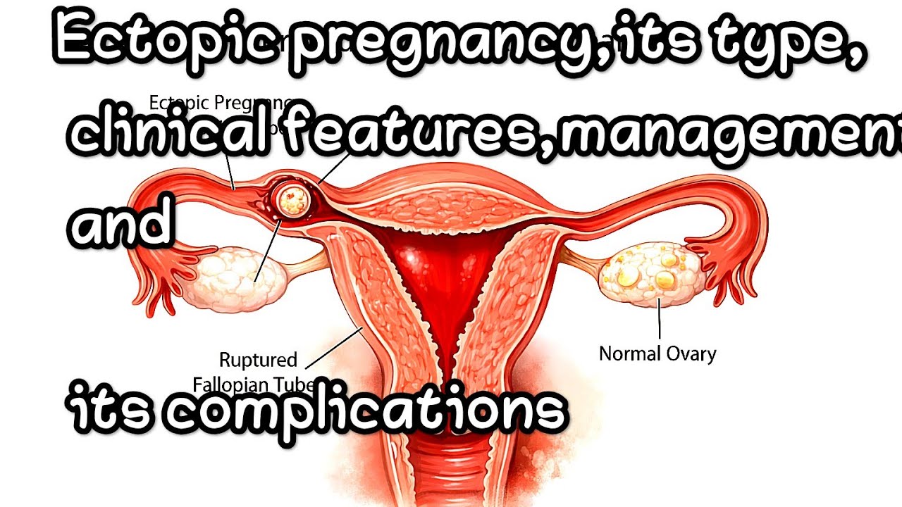 Ectopic pregnancy  #neet pg #inicet#btr