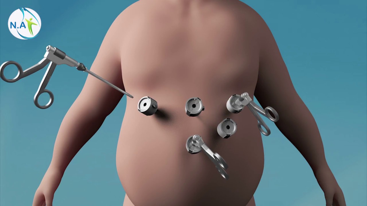 عملية تكميم المعدة مع فحص التسريب | خطوات اجراء عملية تكميم المعده في الاردن | الدكتور نضال عمرو