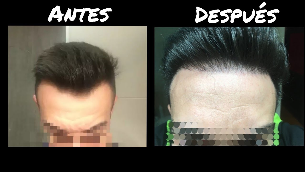 Cl&iacute;nica de poner pelos MC360 en Madrid da el CAMPANAZO