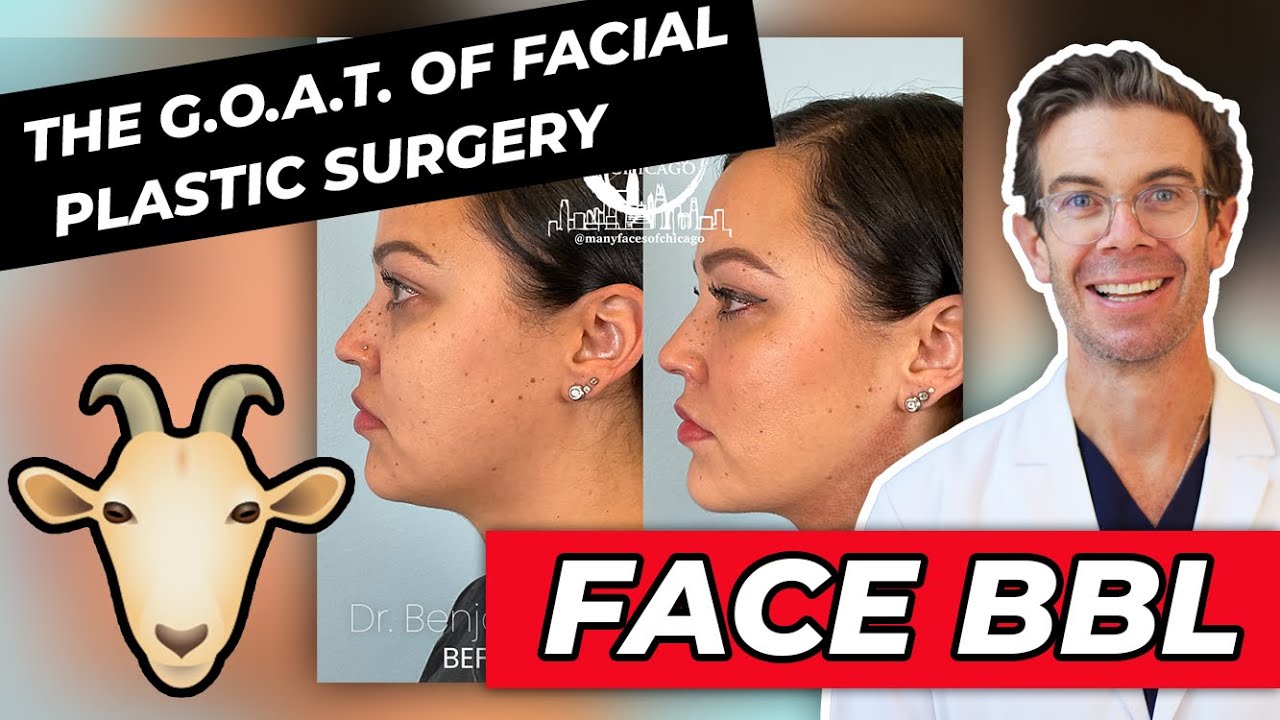 FaceBBL ? |  how much does a FaceBBL&copy; cost? | Face Fat Transfer + Sculpting By Dr. Caughlin = Magic!