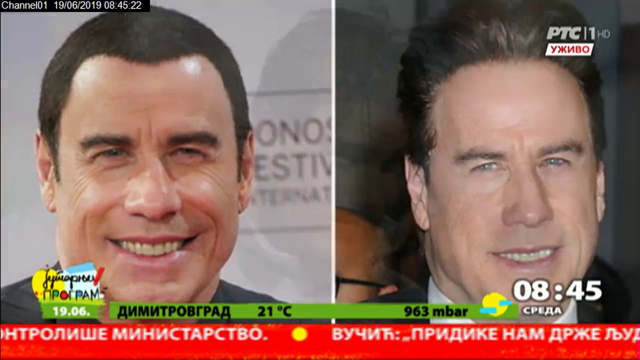 Transplantacija kose