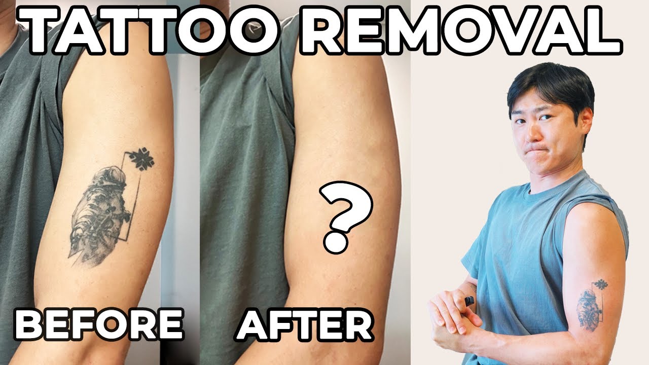 I Lost A Bet and Got My Tattoo Removed