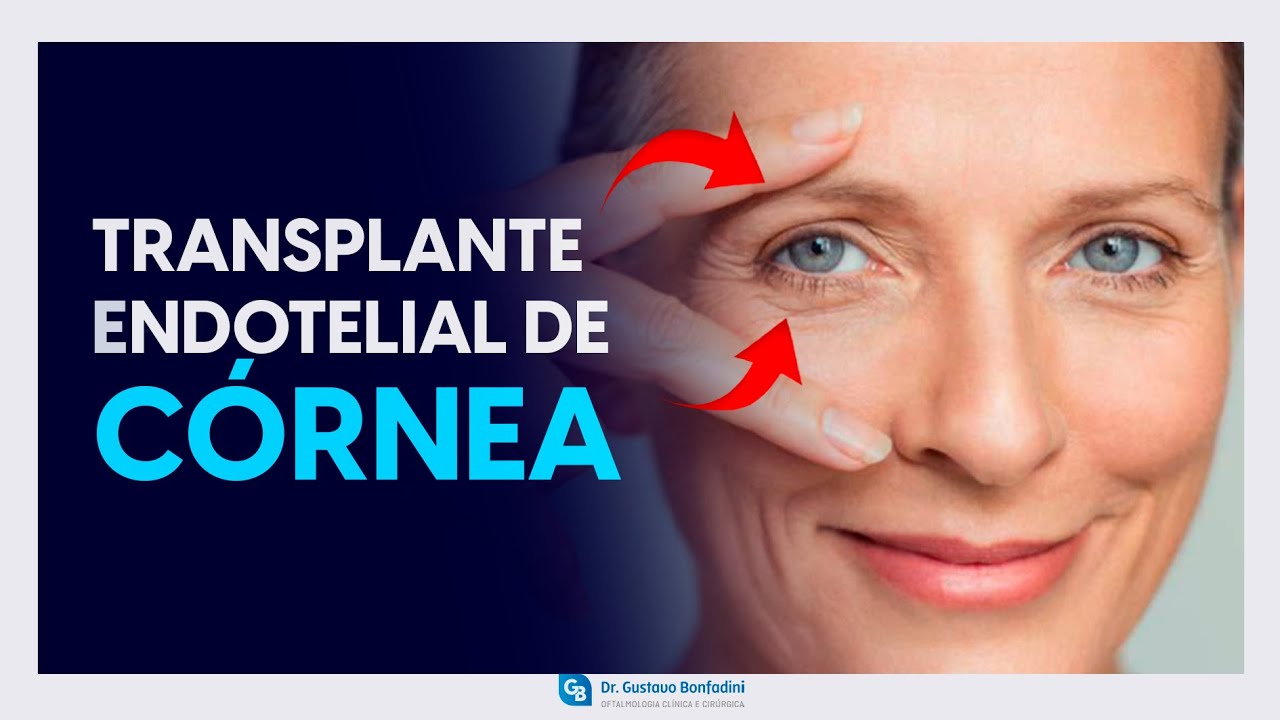 Transplante Endotelial de córnea, DMEK - Dr.Gustavo Bonfadini