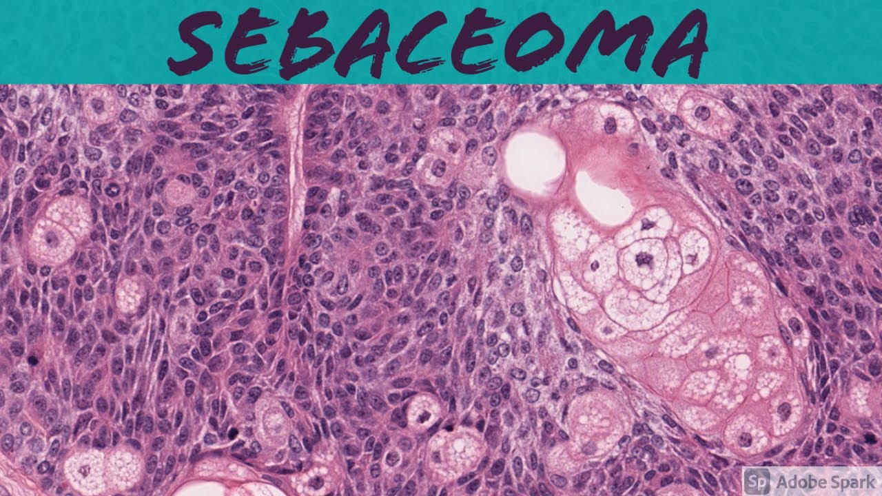 Sebaceoma: 5-Minute Pathology Pearls