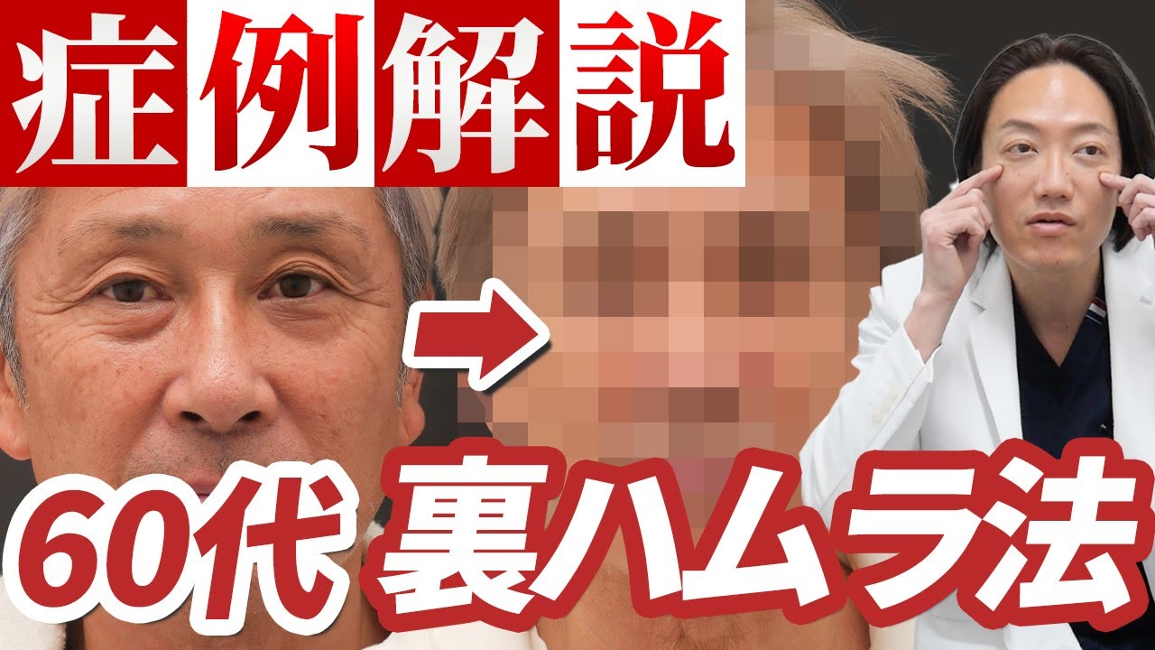 【裏ハムラ】症例解説！ダウンタイムの経過や施術のポイントも解説