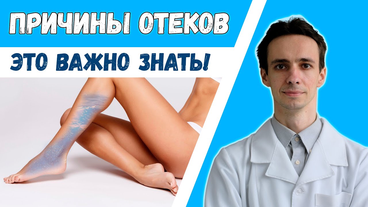 ПОЧЕМУ ОТЕКАЮТ НОГИ? Асцит. Болезни сердца. Недостаток белка....