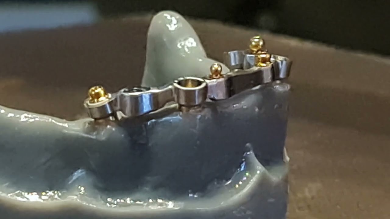 Overdenture attachments
