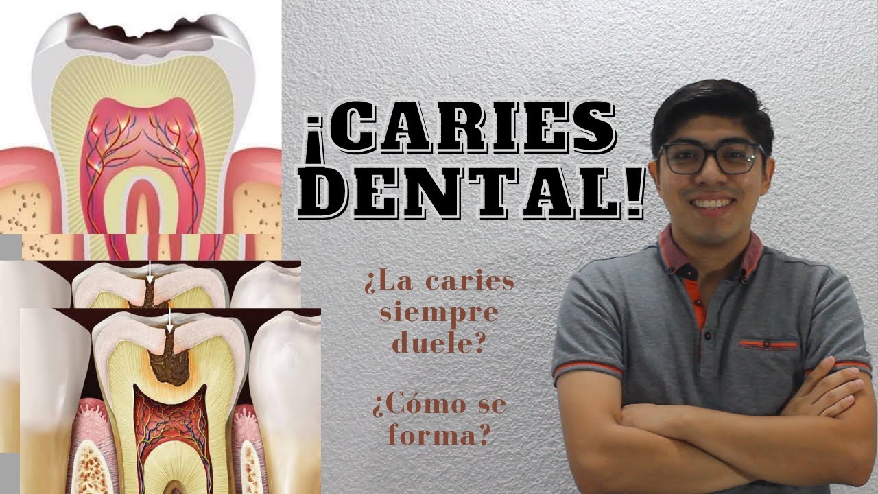 Caries dental. Todo lo que debes saber!