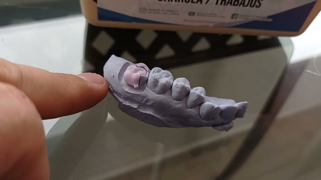 CORONA EMAX EN 15 MINUTOS