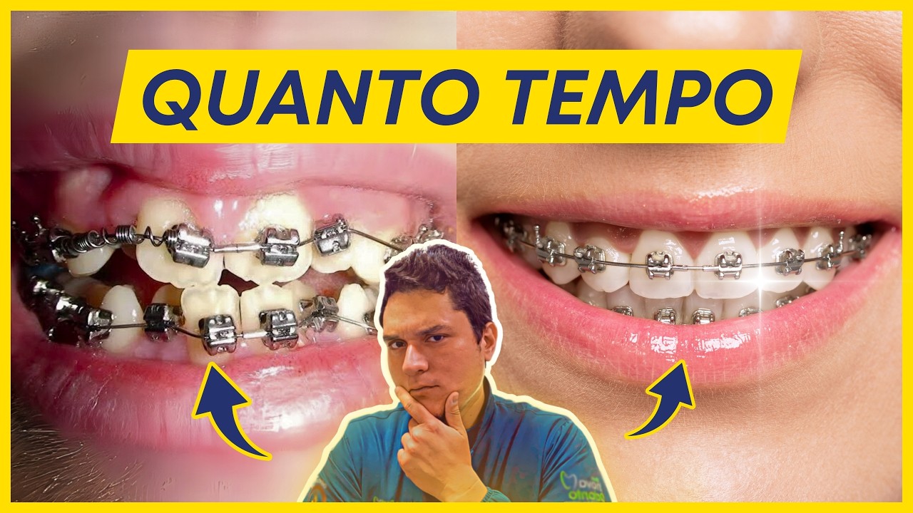 QUANTO TEMPO DEMORA PARA ALINHAR OS DENTES COM APARELHO ORTODÔNTICO?