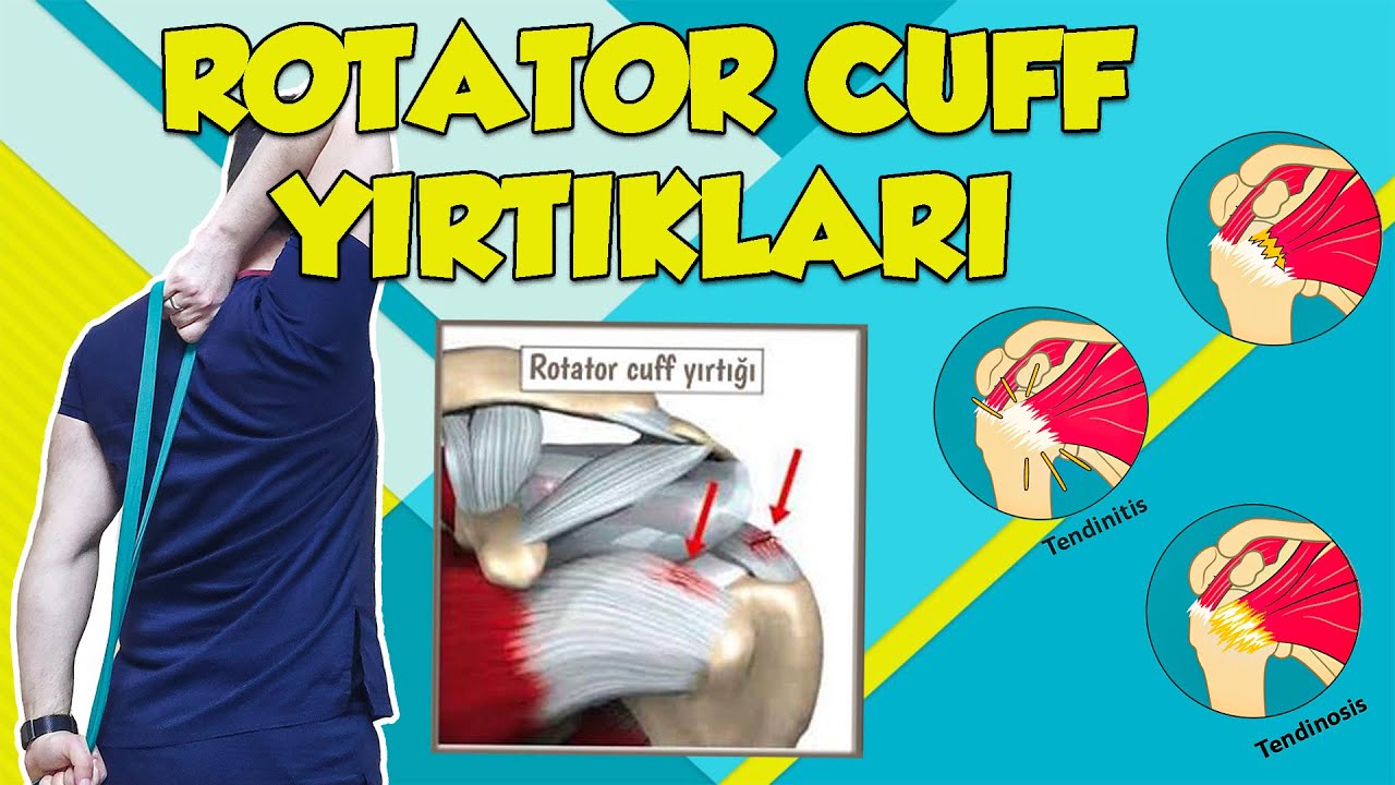 ROTATOR MANŞET YIRTIĞI Egzersizleri | Omuz Kas Yırtığı Ameliyatsız Tedavisi (Uzman Fizyoterapist)