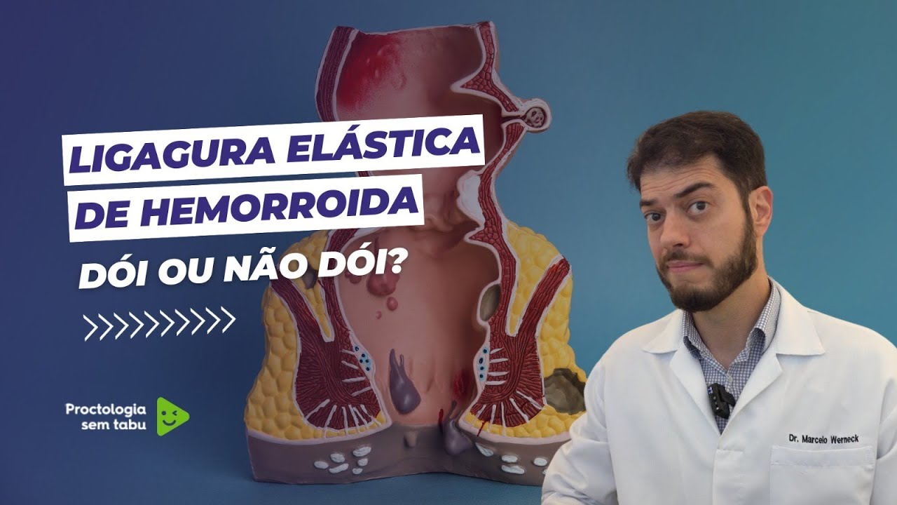 Ligadura elástica doi ou não doi? Ligadura elástica de hemorroidas.
