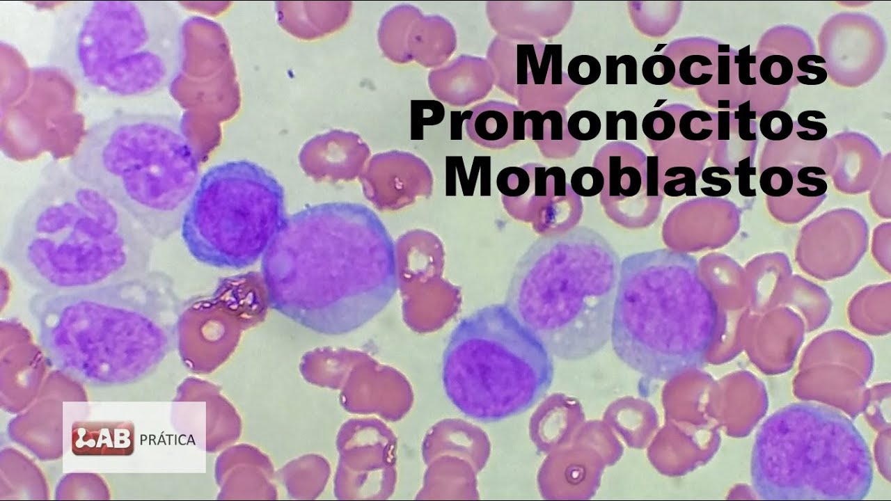 MONÓCITOS  X  PROMONÓCITOS  X  MONOBLASTOS