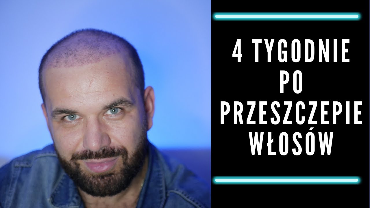 Przeszczep włos&oacute;w w Turcji  - 4 tygodnie po zabiegu.