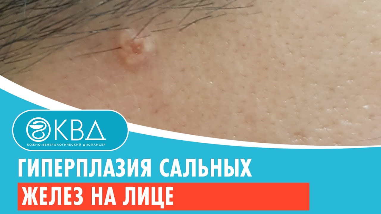 👨‍🦱 Гиперплазия сальных желез на лице. Клинический случай №1003