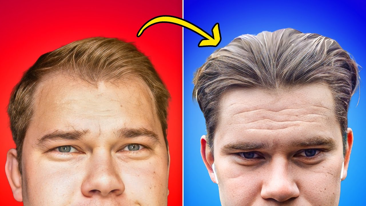 How Did I Regrow Hairline In 12 Months