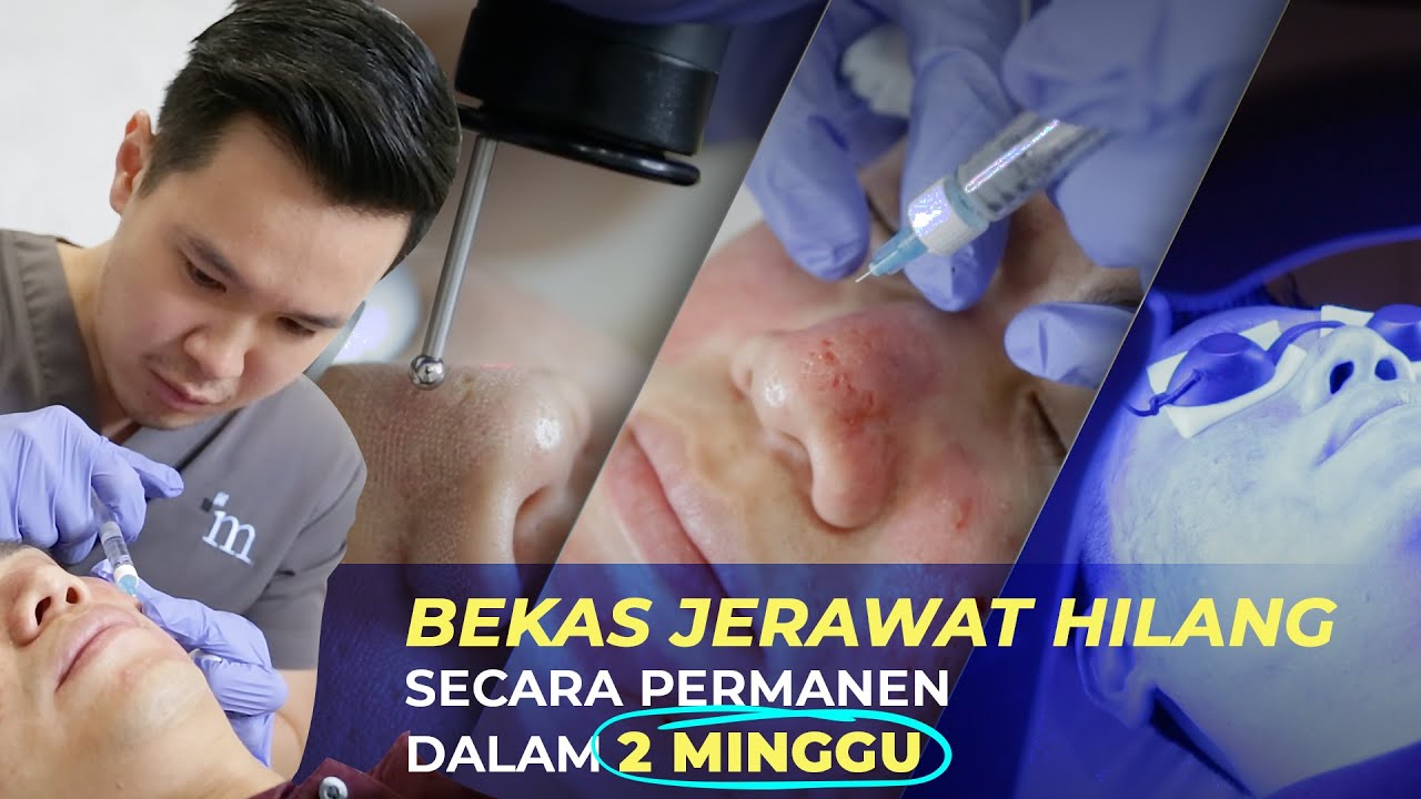 HILANGKAN ACNE SCARS ATAU BEKAS JERAWAT SECARA PERMANEN!