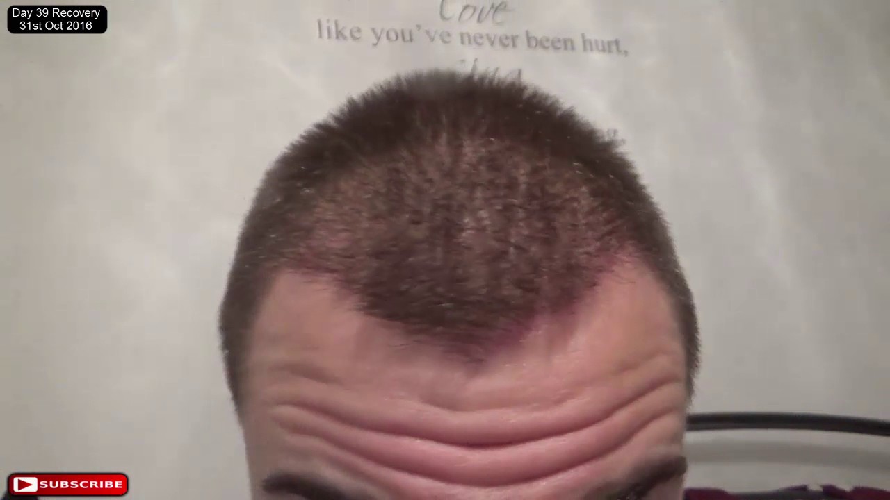 FUE Hair Transplant: Day 39 Post Op Recovery