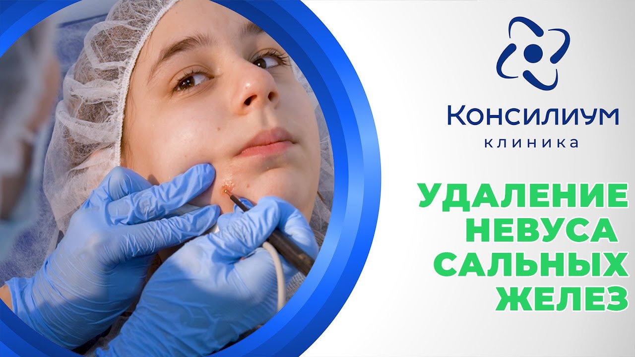 Удаление невуса сальных желез