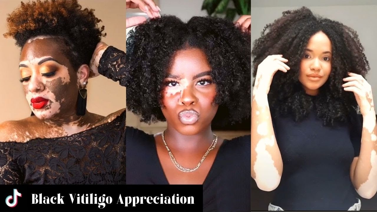 Black Vitiligo Appreciation Compilation | Black Girl TikTok
