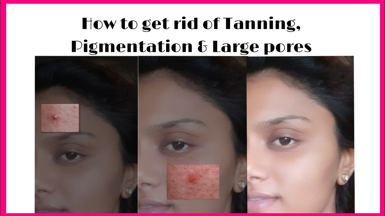 How to get rid of Large Pores, Pigmentation and Skin-Tanning|in Hindi Naturally| by DIVYA ERRAM