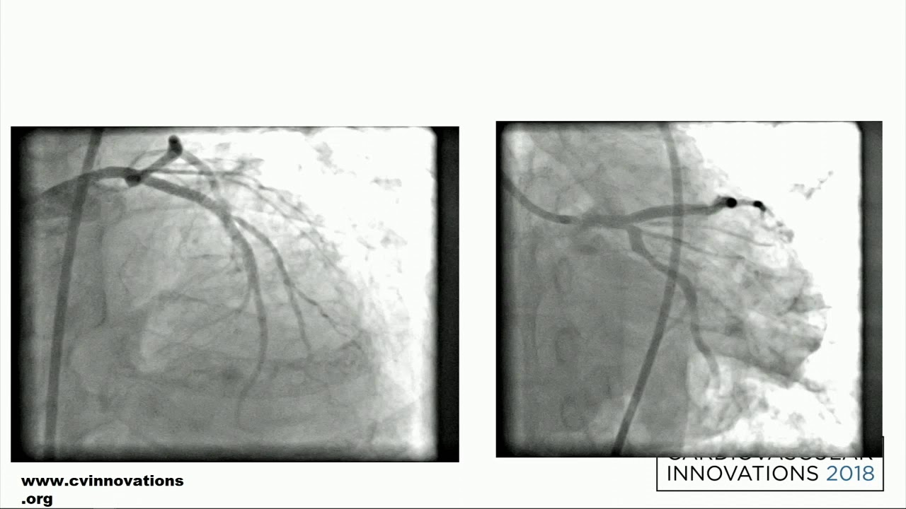 CVI 2019_Thursday, 7/18_ Coronary Challenging Case Competition Semifinals_Thomas George, MD, DNB