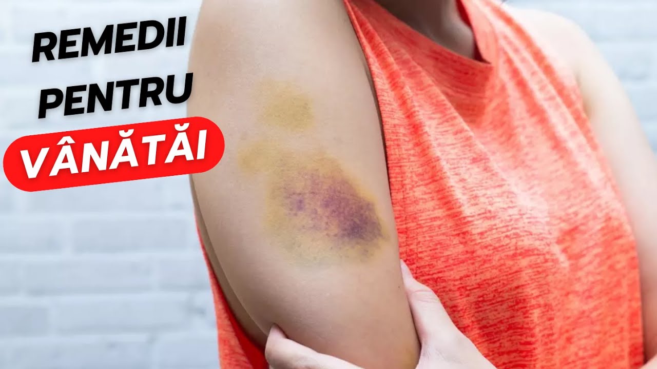 Remedii naturale și eficiente pentru vânătăi. Cum scapi de vânătăi peste noapte | vreausastii