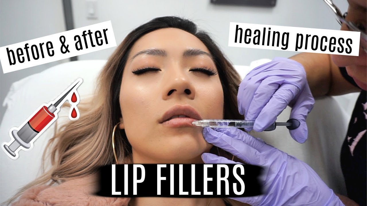 GETTING LIP FILLERS FOR THE FIRST TIME!! | lip injections vlog experience - LaserAway NYC