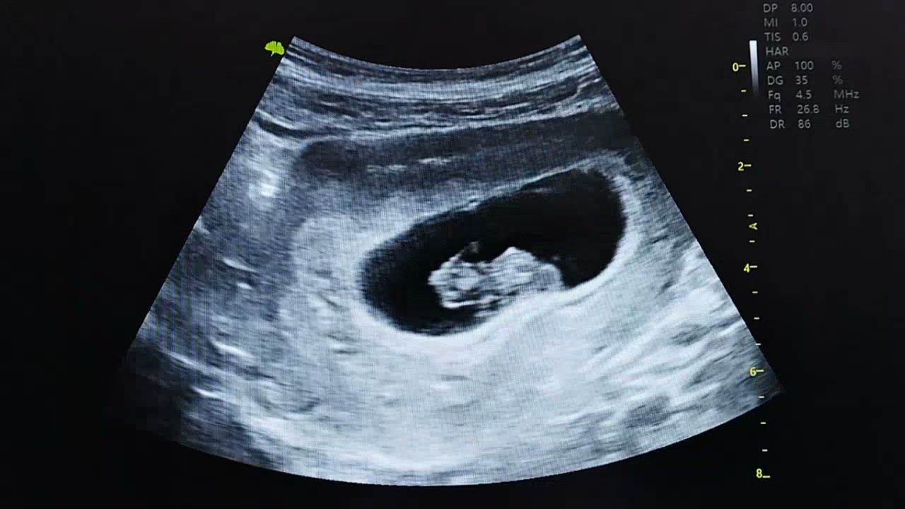 2 MESES DE EMBARAZO ULTRASONIDO NORMAL EMBRIÓN MUY ACTIVO CRECIMIENTO UTERINO NORMAL