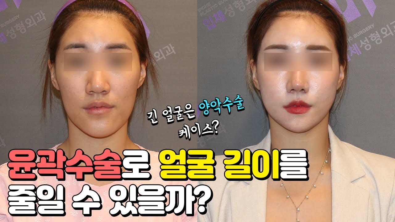 긴얼굴, 긴턱 효과적으로 줄이는 방법?! (feat. 안면윤곽수술)