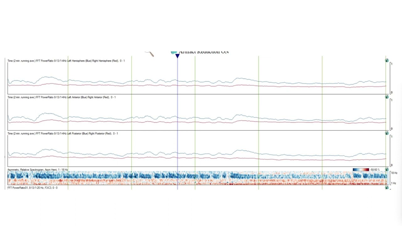 Quantitative EEG: ADR (Alpha Delta Ratio)