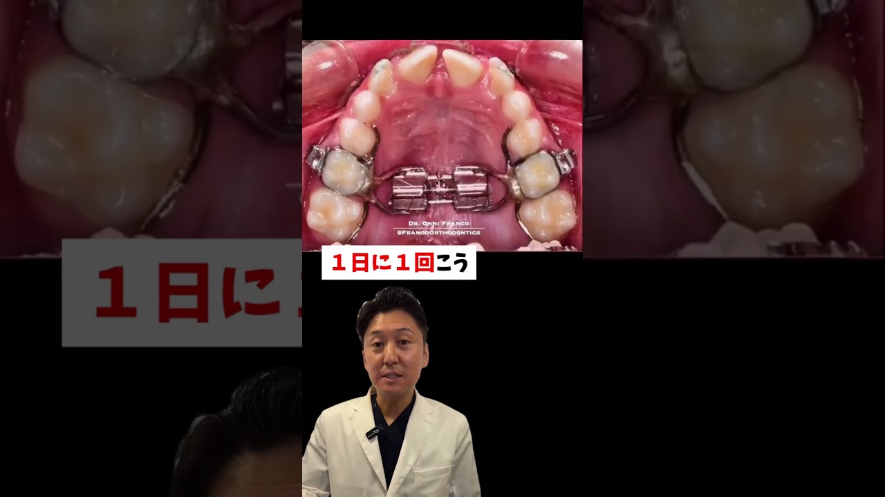 ごついですが効果はバツグンです☺️#蒲田 #矯正 #矯正歯科 #歯医者 #歯並び