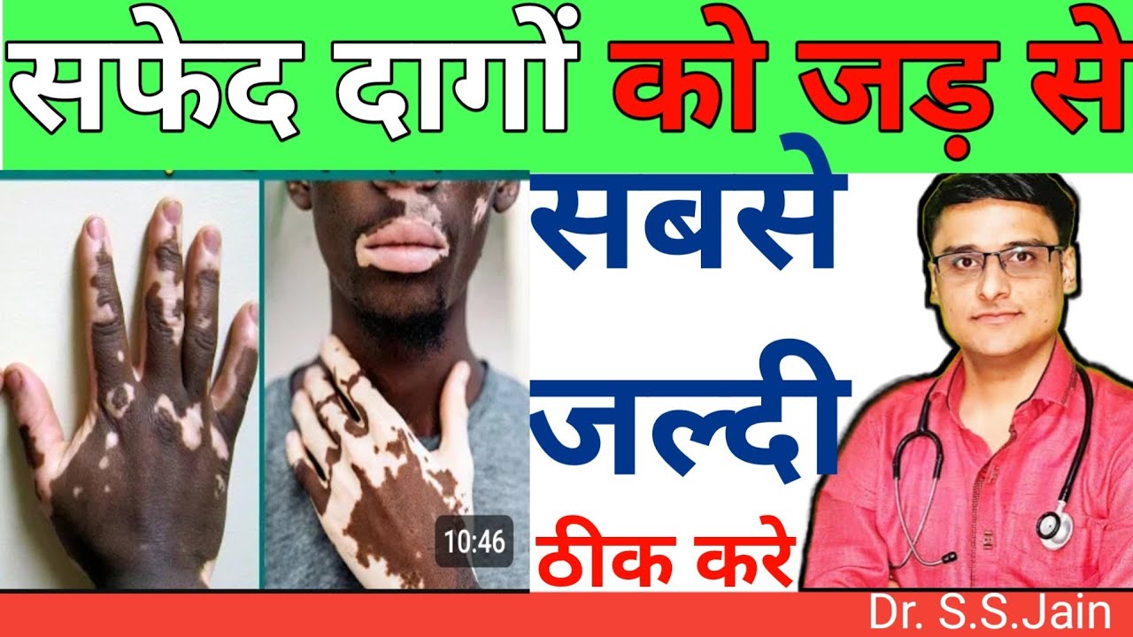 safed daag ka ilaj, vitiligo treatment, white spots treatment, leucoderma treatment ,