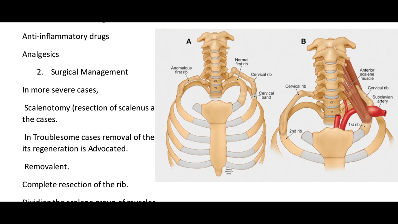 cervical rib 