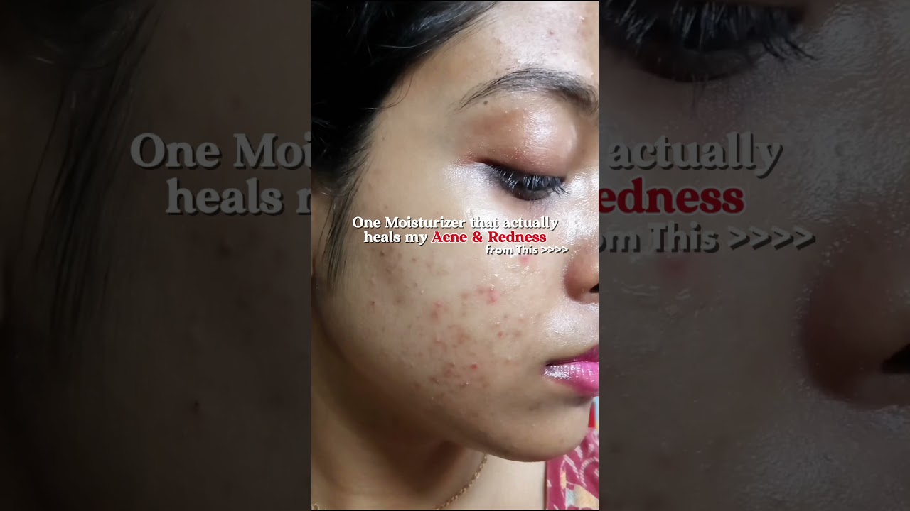 in the caption 👇🏻 Best Moisturizer for Oily Acne-prone Skin for Damaged Skin Barrier, redness, Acne