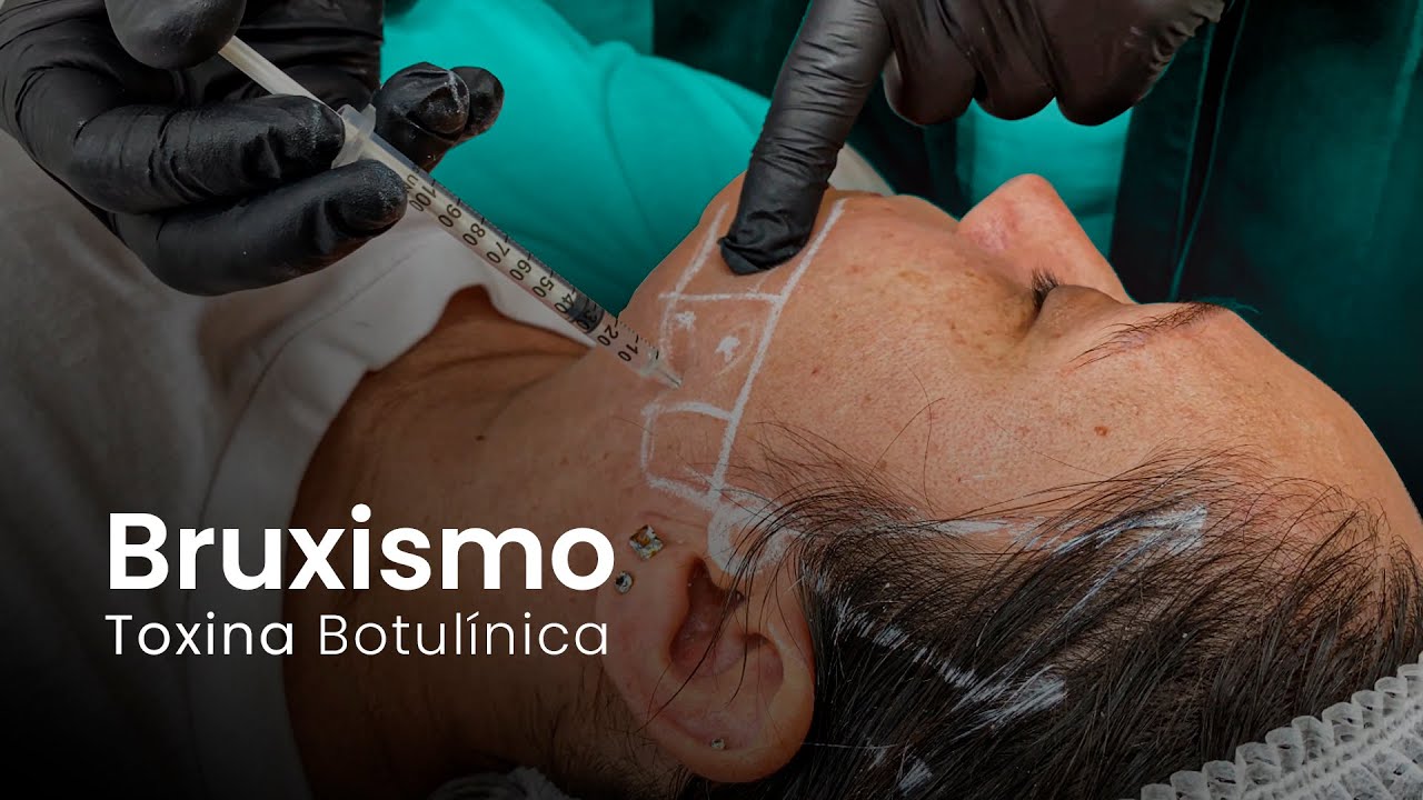 COMO FAZER O PROCEDIMENTO DE BRUXISMO? - Toxina Botulínica